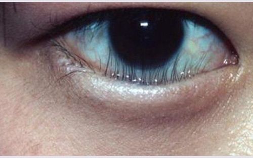 Enlarged eyelids in children and adults