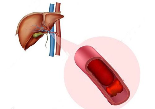 What is portal vein thrombosis?