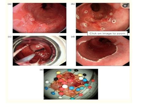 EMR technique in gastrointestinal polyp removal