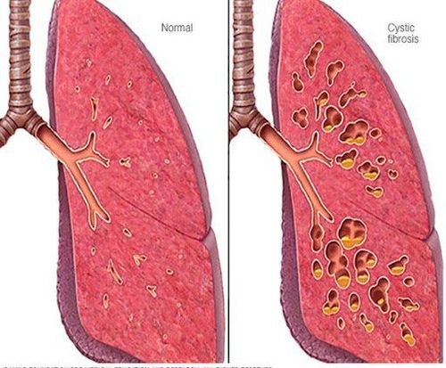 
Hiện vẫn chưa có phương pháp nào giúp chữa bệnh xơ nang
