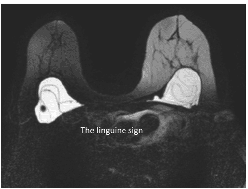 
Hình ảnh MRI vỡ túi ngực trong bao tuyến vú hai bên với dấu hiệu 