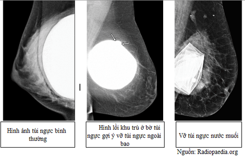 Vỡ túi ngực (Breast Implant Rupture)