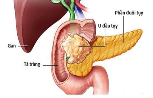 
Nguyên nhân của ung thư thư tuyến tụy là không rõ.
