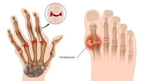 Đó là bệnh Gout hay giả Gout?