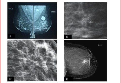 
Các dạng tổn thương trên nhũ ảnh (Nguồn: American College of Radiology)
