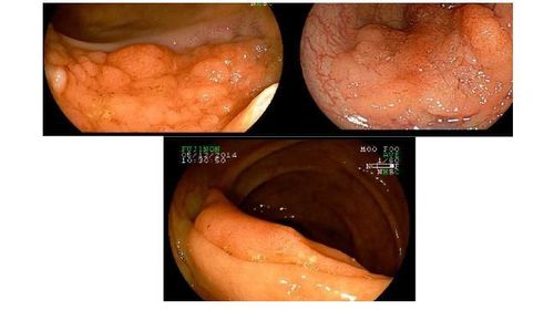 
Polyp dạng LST được phát hiện qua nội soi
