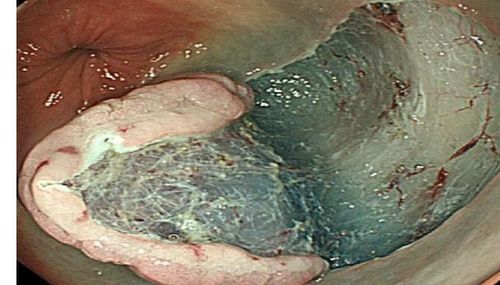 Các khối u tân sinh đại trực tràng không polyp: Phân loại, điều trị và theo dõi