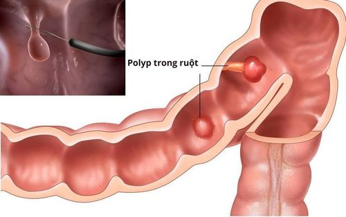 Polyp u tuyến loạn sản vừa có nguy hiểm không?