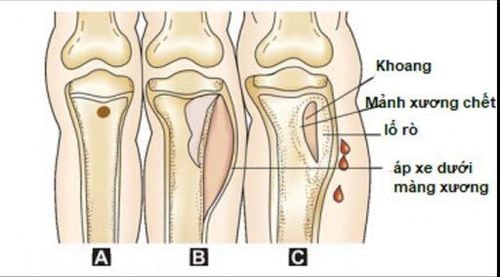 
Viêm xương xảy ra do vi khuẩn xâm nhập nên cần được phẫu thuật lấy xương chết
