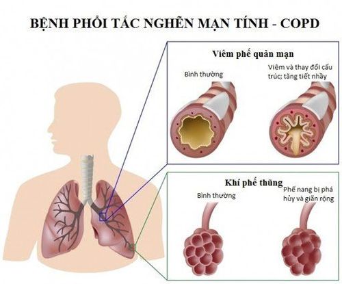 Đợt cấp bệnh phổi tắc nghẽn mạn tính