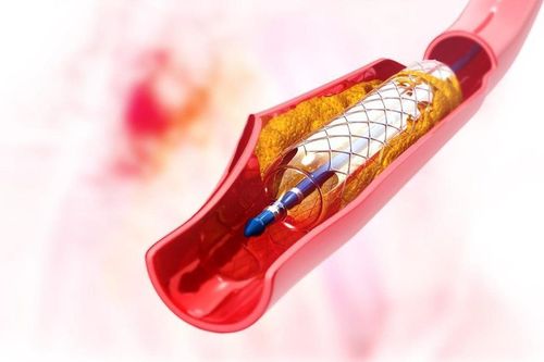 Durability of coronary stents