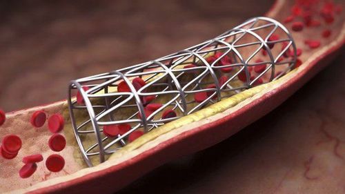 
Giải đáp đặt stent mạch vành được bao lâu?
