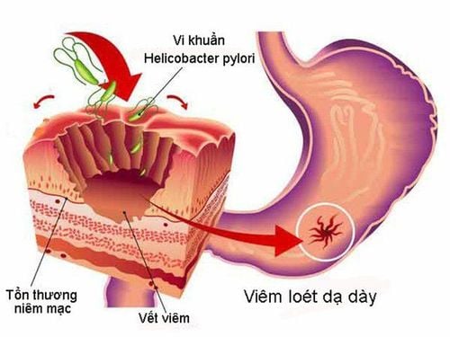 
H.pylori gây nên các bệnh lý ở dạ dày tá tràng
