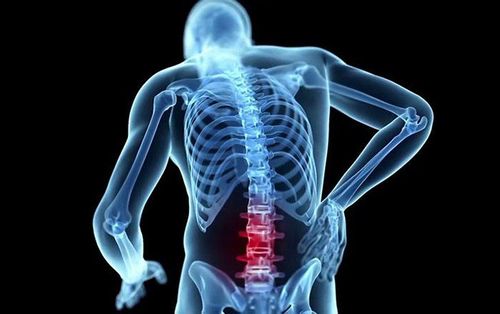 Surgery to decompress spinal cord in tuberculosis of the spine