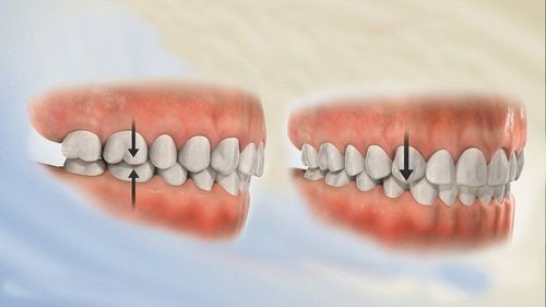 Phương pháp điều trị lệch răng giữa hàm trên và hàm dưới?