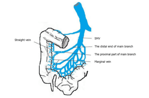 
Minh họa bằng đồ thị về sự phân bố vôi hóa trong tĩnh mạch mạc treo tràng trên. SMV: Tĩnh mạch mạc treo tràng trên.
