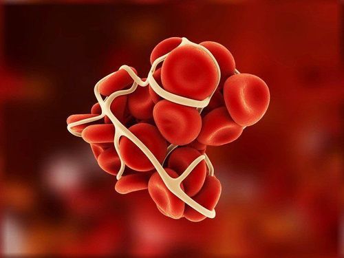 Một số người bị ung thư phổi có nhiều khả năng hình thành cục máu đông