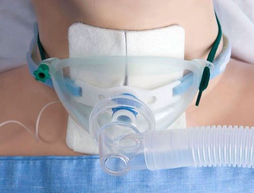 What you need to know about tracheostomy