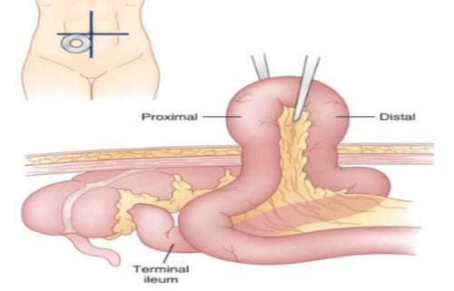 
Mở hồi tràng ra da à một trong những phẫu thuật chữa viêm loét đại tràng
