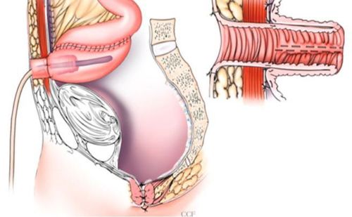 
Mở hồi tràng giữ phân trong ổ bụng là một dạng phẫu thuật chữa viêm loét đại tràng
