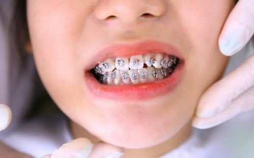 Beware of tooth decay when braces