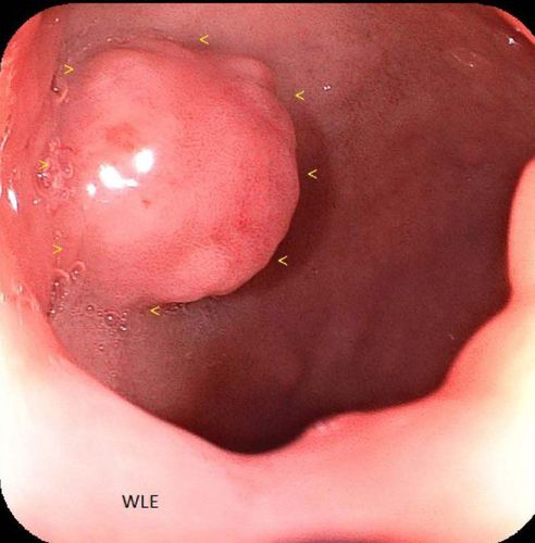 The birth of the term "mixed endothelial tumor"