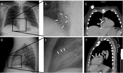 
Hình ảnh vôi hóa mạch vành là một đường cong mờ trên phim chụp X quang ngực (A, B, D, E) và rõ ràng hơn trên phim CT tương ứng (C, F).
