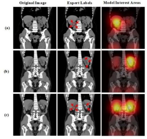 
Hình ảnh CT gốc (original image), hình ảnh được các chuyên gia dán nhãn (expert labels), và hình ảnh được AI đọc (model interest areas).
