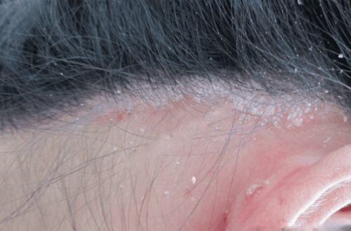 Điều trị vảy nến da đầu khoảng bao lâu?