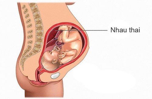 Thai nhi 24 tuần bị rau tiền đạo, rau cài răng lược có sao không?