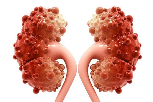 Polycystic kidney disease (PKD)