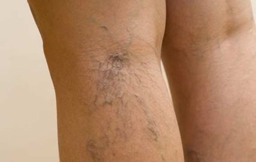 Should medication be used to treat varicose veins?