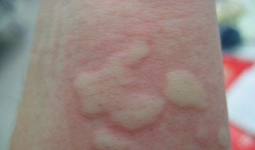 8 causes of chronic idiopathic urticaria that you do not know