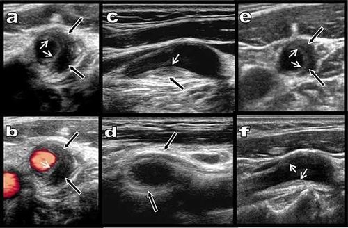 
Hình 1: Siêu âm (a-d) dày thanh mạc hồi âm kém lệch tâm đoạn bóng cảnh (mũi tên đen). Dải xơ nội mạc tăng âm (mũi tên trắng). Sau 15 ngày (e, f) điều trị với thuốc chống viêm, thành mạch giảm độ dày và còn dải tăng âm nội mạc.
