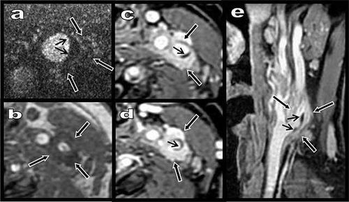 
Hình 2: Siêu âm với thuốc tương phản (a) cho thấy phân bố mao mạch bình thường trong vùng dày giảm âm (mũi tên đen), loại trừ hematoma. Mảng xơ không tưới máu nhỏ (mũi tên nhỏ đen). Hình MRI T1W trước tiêm cho thấy mô giảm tín hiệu quanh đoạn gần động mạch cảnh trong (mũi tên đen, hình a – e), bắt thuốc mạnh mô này trên T1W sau tiêm thuốc (c-e).
