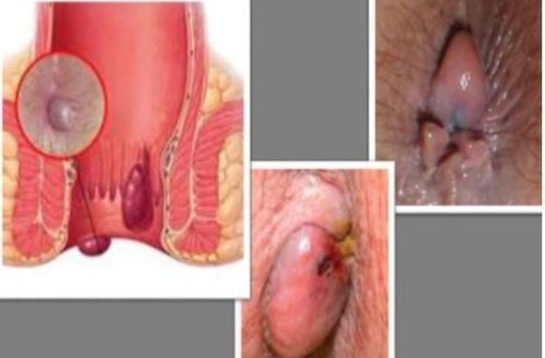 Infective hemorrhoids: Causes and treatments