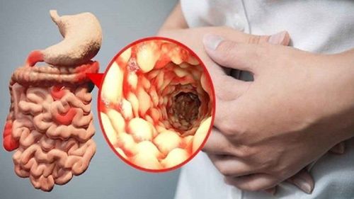 New-onset inflammatory bowel disease after obesity surgery