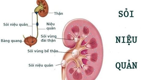 Sau 13 ngày mổ sỏi niệu quản vẫn đau là do đâu?