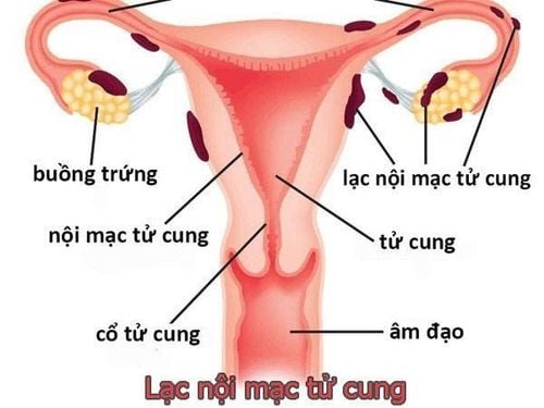 
Lạc nội mạc tử cung là bệnh lý nguy hiểm có thể gây ra các cơn đau bụng dưới sau khi quan hệ
