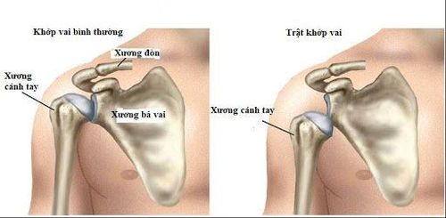 Bán trật khớp vai có thể gây liệt vĩnh viễn hay không?