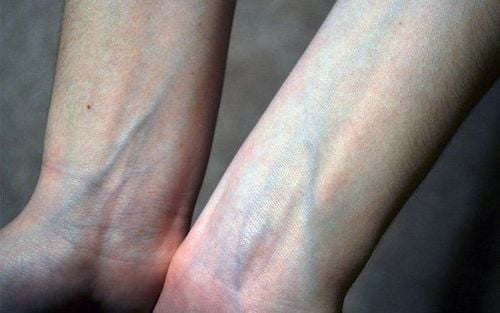 Blue line on hands, chest, legs is what disease?