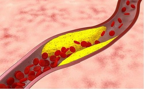 Close-up: Emergency intervention for coronary artery occlusion for smokers