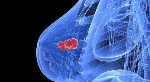 Medical methods in the treatment of breast cancer