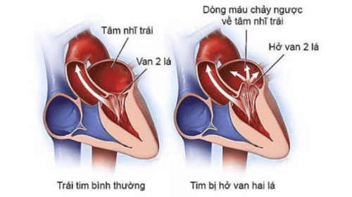 Mitral regurgitation 1.5/4 with bradycardia how to treat?