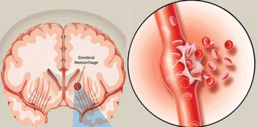 Người bệnh xuất huyết não, phù não phải điều trị thế nào?