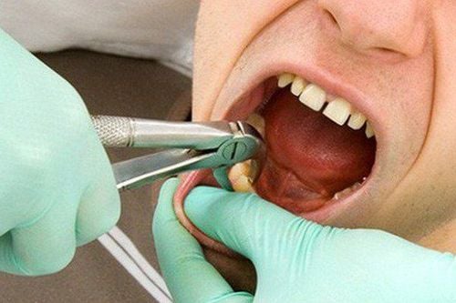 Should teeth be extracted while taking anticoagulants?