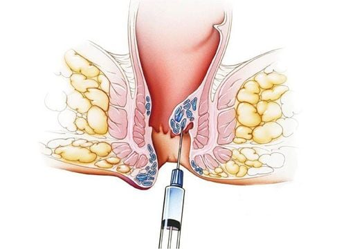 Vaginal bleeding and bloody stools after sclerotherapy internal hemorrhoids?