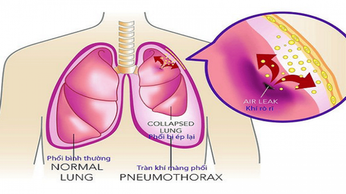 Tràn khí màng phổi điều trị bao lâu?