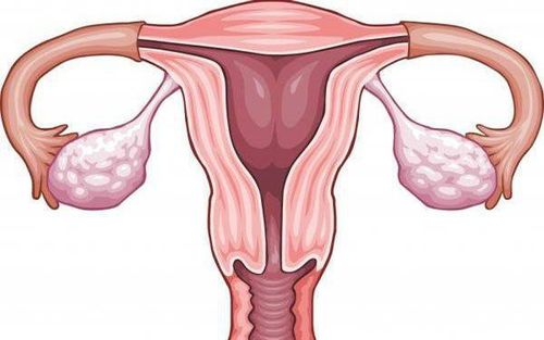 Does a retroverted uterus affect fertility?