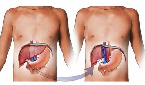 
Ghép gan là phẫu thuật mà bác sĩ thay thế gan bệnh bằng gan lành khỏe mạnh, từ người cho sống hoặc từ nguồn hiến chết não.
